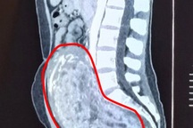 Khối u tử cung khổng lồ chiếm trọn ổ bụng bệnh nhân