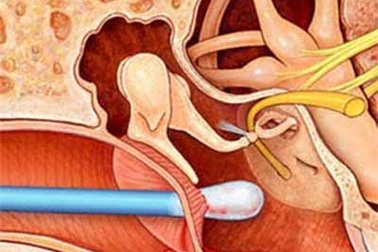 Có biến chứng sau khi thủng màng nhĩ?
