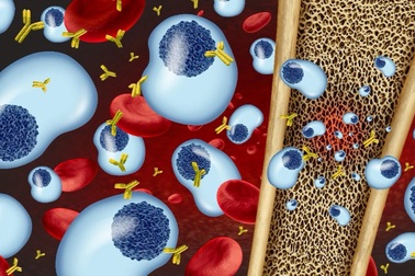 Hy vọng mới cho bệnh nhân đa u tủy xương tại Việt Nam