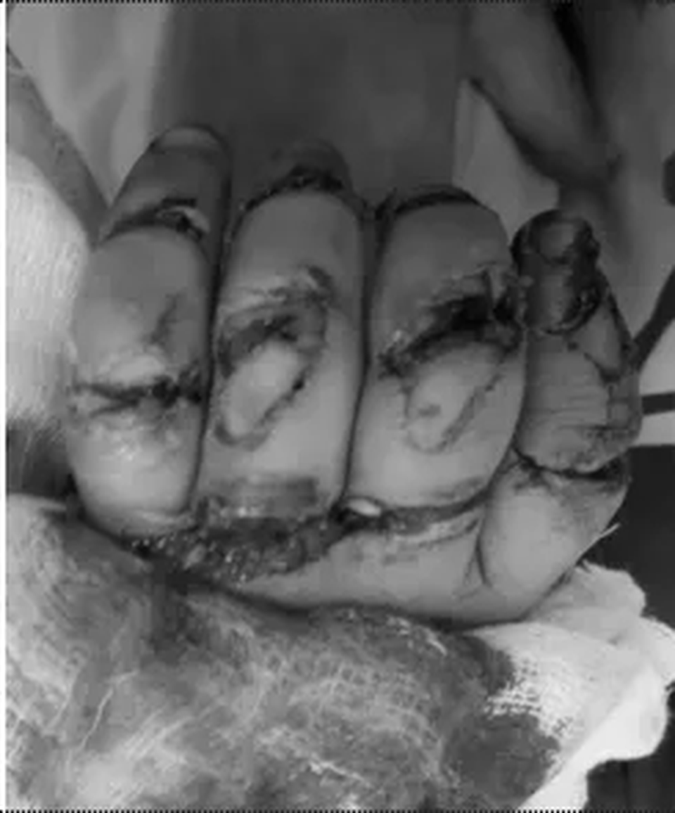 Bệnh nhi 23 tháng tuổi suýt mất 5 ngón tay vì máy rửa xe - 1