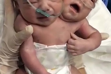 Em bé hai đầu ra đời ở Mexico khiến họ hàng choáng váng