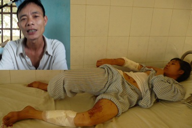 Có thể khởi tố kẻ tạt nồi canh nóng vào người vợ