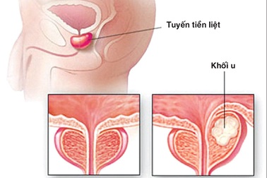 Ung thư tiền liệt tuyến có thể chữa lành?