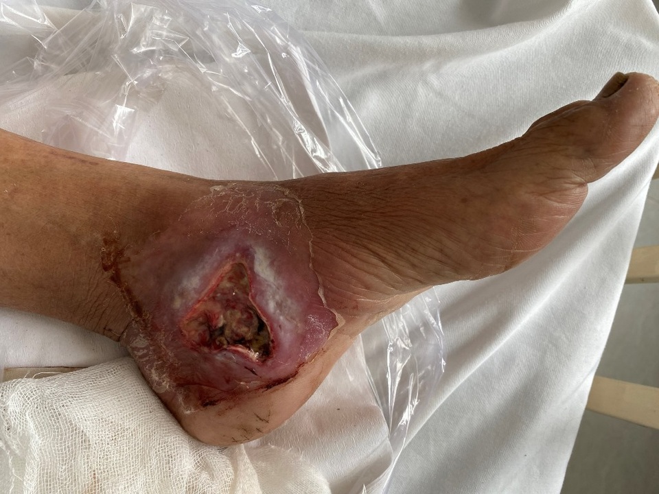 Gần 2 triệu người mắc bệnh đái tháo đường chưa được chẩn đoán, điều trị - 2 Gần 2 triệu người mắc bệnh đái tháo đường chưa được chẩn đoán, điều trị - 2