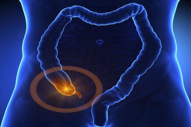 Đau vùng hạ vị có thể là triệu chứng cảnh báo khối u ruột thừa