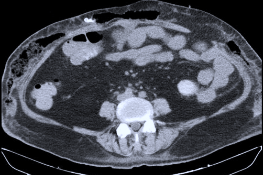 Người phụ nữ thủng ruột nguy kịch sau hút mỡ, 81 ngày chống chọi tử thần - 1