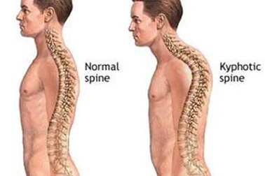 Tư vấn miễn phí các bệnh về cột sống
