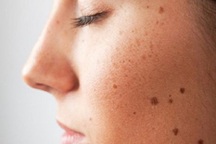 Có đặc điểm này bạn cần đề phòng ung thư da