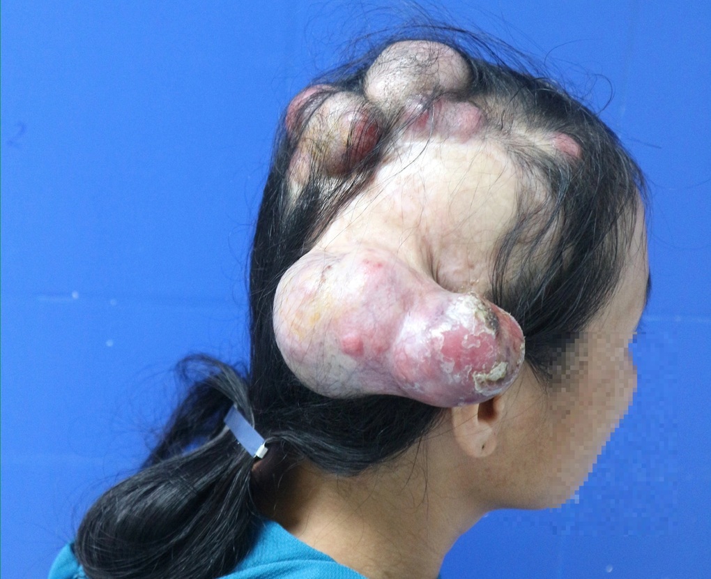 Người phụ nữ mọc sừng kỳ lạ một nửa đầu, to đến 20cm - 1 Người phụ nữ mọc sừng kỳ lạ một nửa đầu, to đến 20cm - 1