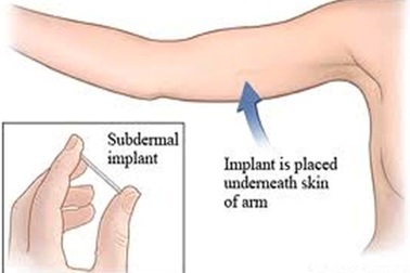 Que cấy tránh thai - Phương pháp tránh thai an toàn cho giới trẻ