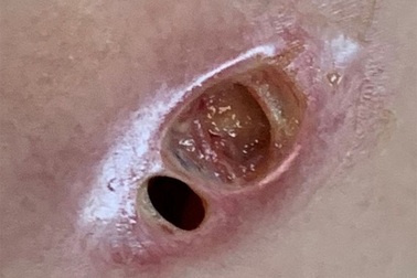 Thủng ngực vì “nâng cấp” vòng một, hiểm họa từ làm đẹp bằng silicon