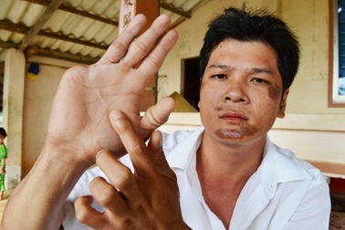 Chém người đứt bàn tay nhưng công an kết luận: “không phạm tội” !  