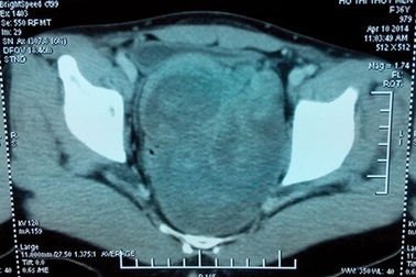 Mổ thành công khối u lớn trước xương cùng cụt