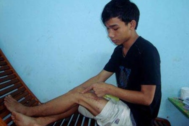 Những sự cố “quên” dụng cụ trong người bệnh nhân sau phẫu thuật