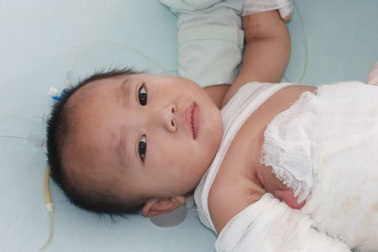 Ngã vào nồi nước sôi, bé 21 tháng tuổi nguy kịch 