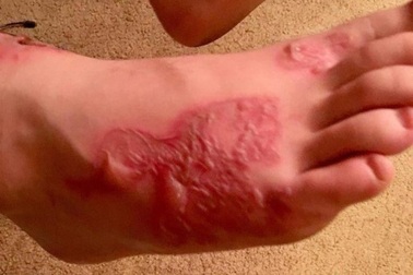 Vùi chân xuống cát biển, cậu bé "mở đường" cho giun vào cơ thể sống ký sinh