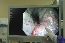 Nhờ hóc thịt ngan, người đàn ông phát hiện kịp thời ung thư thực quản