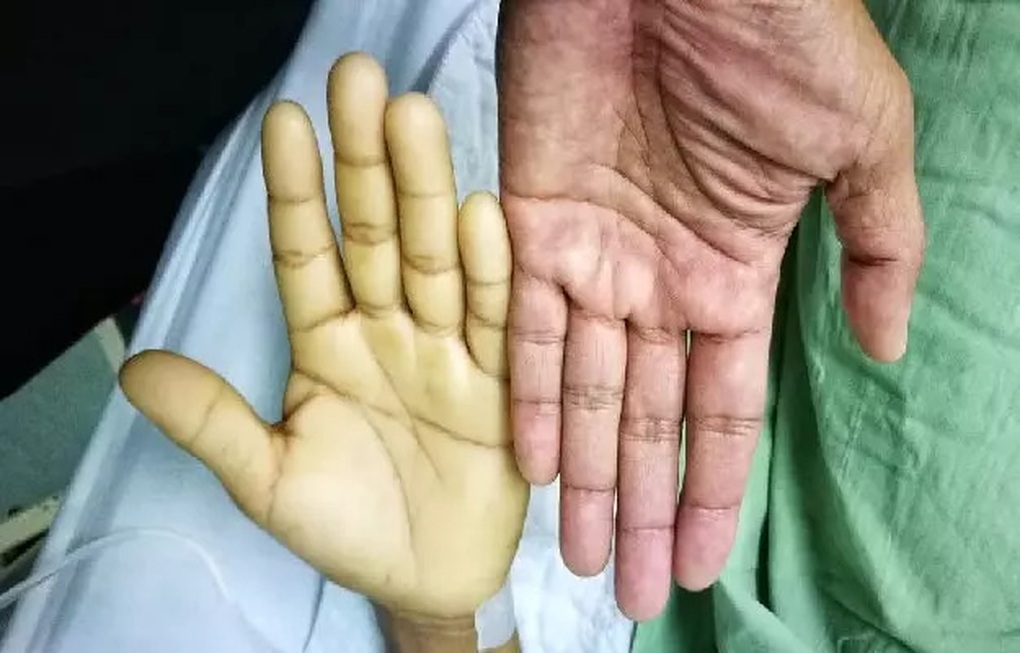 Hiểu lầm phổ biến về sữa của cha mẹ khiến bé 3 tuổi phải truyền máu - 1 Hiểu lầm phổ biến về sữa của cha mẹ khiến bé 3 tuổi phải truyền máu - 1