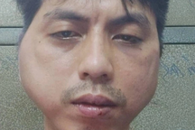 Nhân viên bị chủ quán lẩu đánh biến dạng khuôn mặt: Thương tích 7%