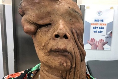 “Quỷ” bướu sợi thần kinh ám thân xác người bệnh