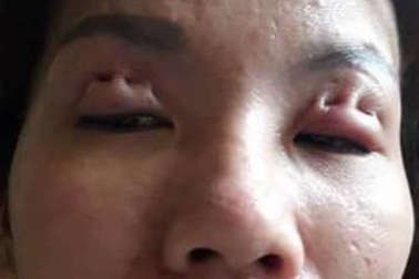 Chuyên gia tạo hình: Nhấn mí, cắt mí là phẫu thuật thẩm mỹ khó nhất!