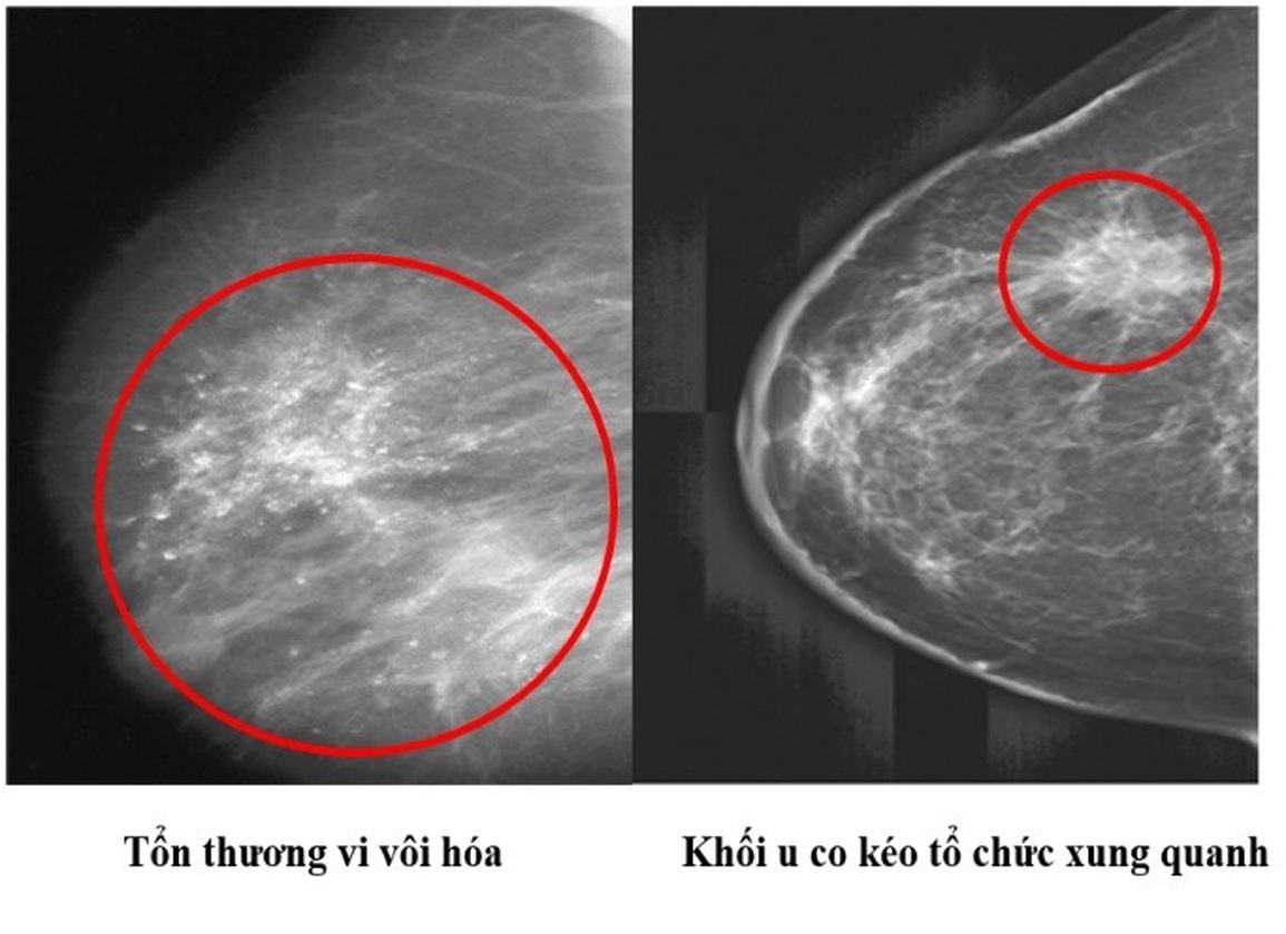 Ý nghĩa của các phương pháp sàng lọc ung thư vú - 3 Ý nghĩa của các phương pháp sàng lọc ung thư vú - 3