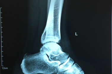 Sau 1 năm chơi bóng đá, nam thanh niên mới được phát hiện chấn thương chân vị trí hiểm