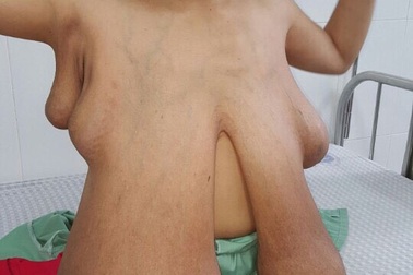 Cặp ngực khủng hy hữu nặng tới 15kg