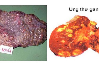 Chuyên gia lý giải vì sao ung thư gan vọt lên vị trí đầu bảng