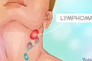 Ung thư hạch: Dấu hiệu nhận biết, phương pháp điều trị