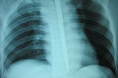 Nuốt dao nhọn dài 15cm để… tự tử