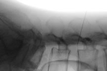 Dị vật 6cm “mắc kẹt” trong thắt lưng vì tự châm cứu