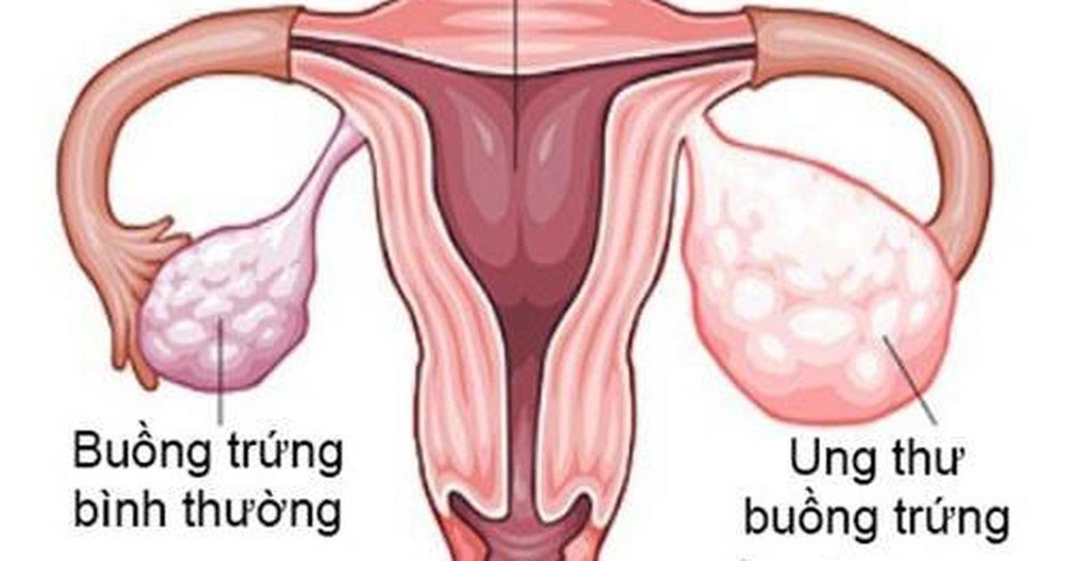 Phụ Lạc Cao EX giúp chị em không còn lo nguy cơ lạc nội mạc tử cung - 1 Phụ Lạc Cao EX giúp chị em không còn lo nguy cơ lạc nội mạc tử cung - 1