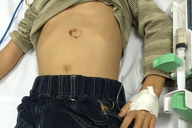 Bé trai 7 tuổi vỡ tụy vì ngã xe đạp