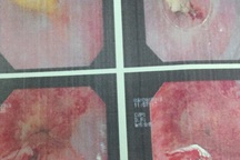 Xương gà đâm thủng thực quản vì mẹ cáu con lúc ăn