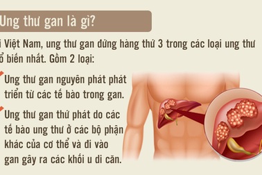 [Inforgraphics]: Dấu hiệu nhận biết sớm ung thư gan