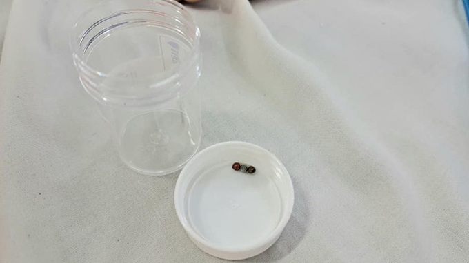 Các viên bi nam châm được lấy ra khỏi ruột bé gái. Ảnh: BVCC