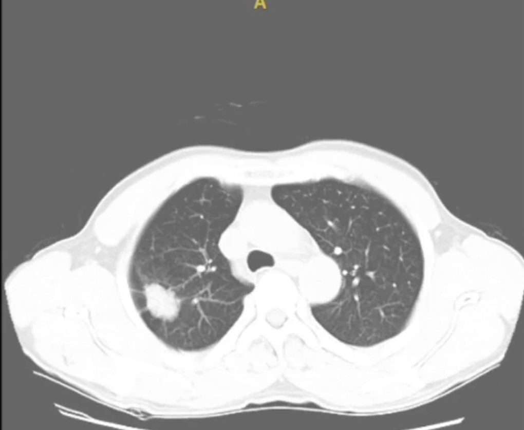Đi khám vì ho, bất ngờ phát hiện bệnh ung thư tử vong cao nhất thế giới - 1