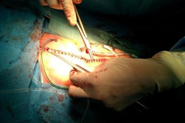 Đóng thành ngực cho bé Phụng trong ca tách cặp song sinh