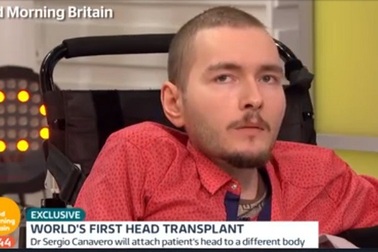 Ca phẫu thuật ghép đầu người đầu tiên đã thành công?