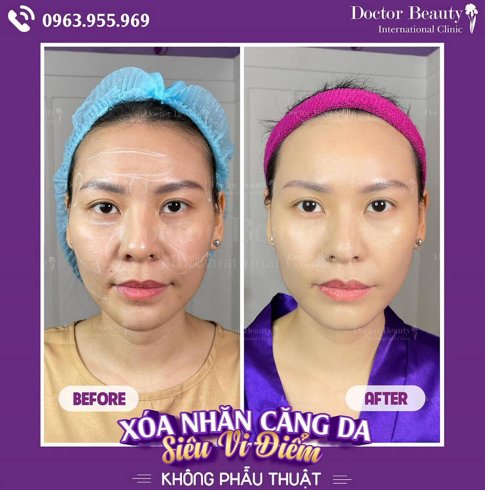 Doctor Beauty International Clinic độc quyền xóa nhăn siêu vi điểm - 2 Doctor Beauty International Clinic độc quyền xóa nhăn siêu vi điểm - 2
