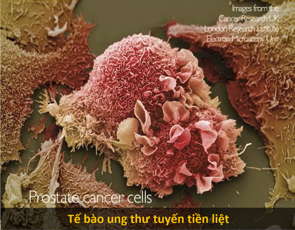 Loại thuốc mới tiếp thêm hy vọng cho bệnh nhân ung thư tuyến tiền liệt - 2 Loại thuốc mới tiếp thêm hy vọng cho bệnh nhân ung thư tuyến tiền liệt - 2