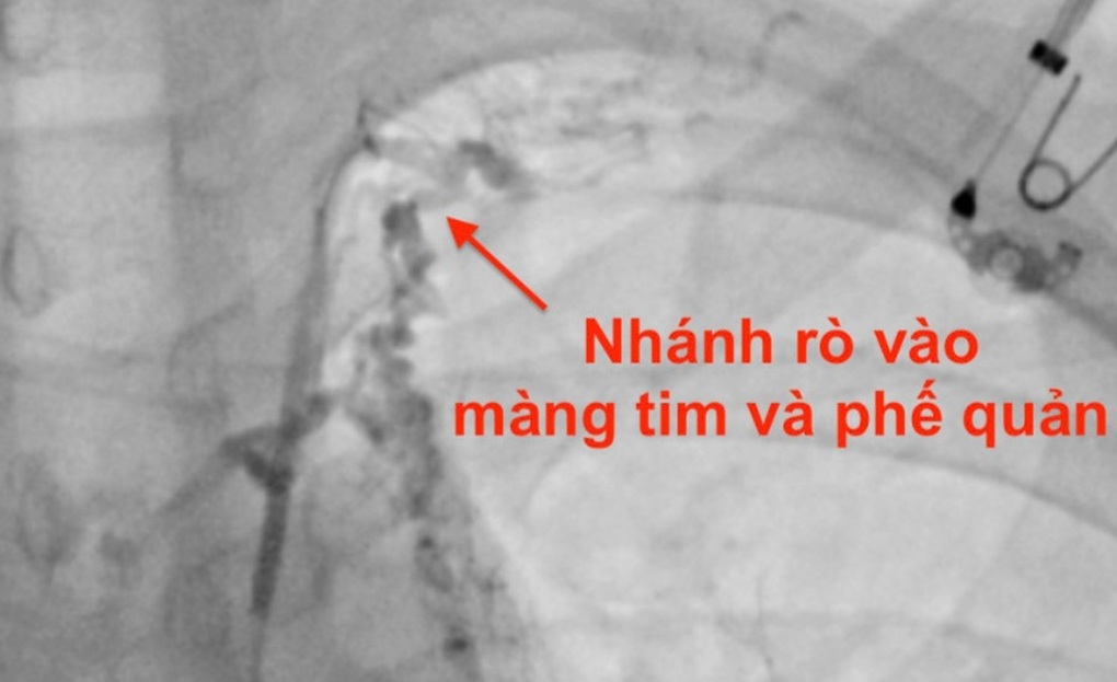 Chàng trai ho khạc ra chất dịch màu trắng đặc sệt giống như thạch - 1