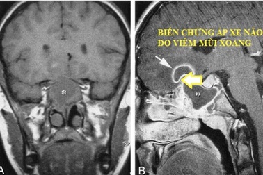 Viêm mũi xoang: Coi chừng biến chứng nguy hiểm khi thời tiết đổi mùa
