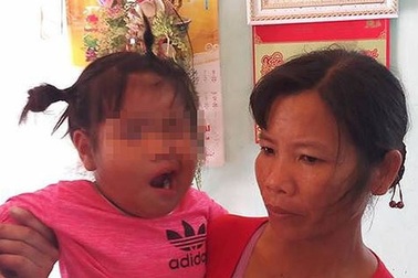 Bé gái 3 tuổi bị liệt dây thần kinh số 7 nghi do cô giáo đánh