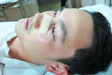 Một thanh niên gãy sống mũi sau khi va chạm với CSGT