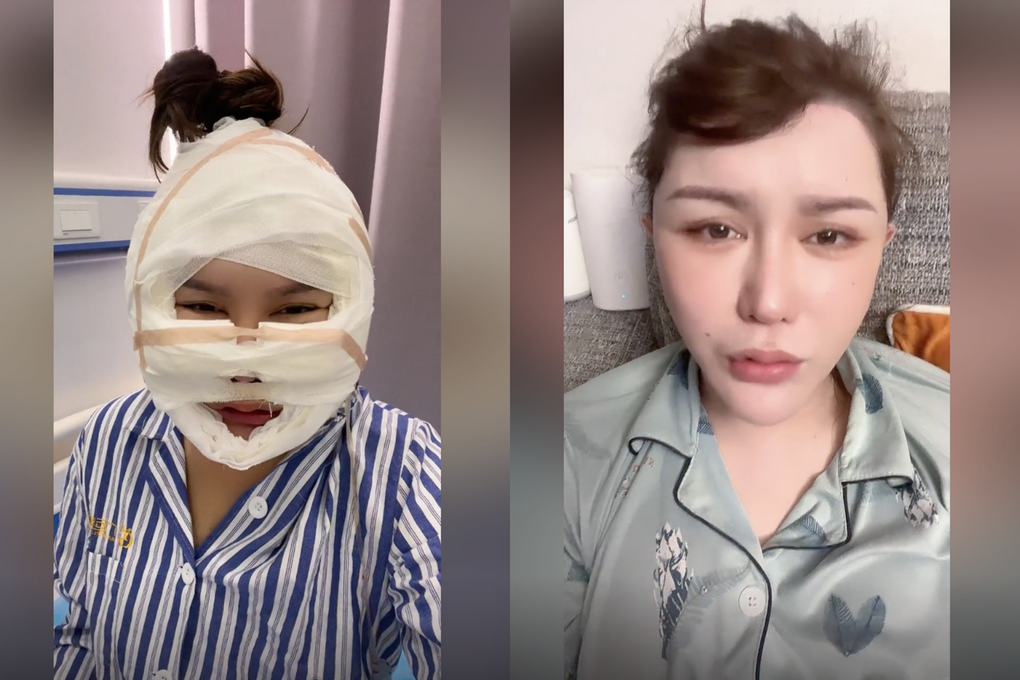 Bỏ 4,5 tỷ đồng dao kéo, cô gái bị biến dạng mặt đến mẹ cũng không nhận ra - 2 Bỏ 4,5 tỷ đồng dao kéo, cô gái bị biến dạng mặt đến mẹ cũng không nhận ra - 2