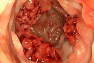 Ung thư đại trực tràng có xu hướng càng gia tăng và trẻ hóa