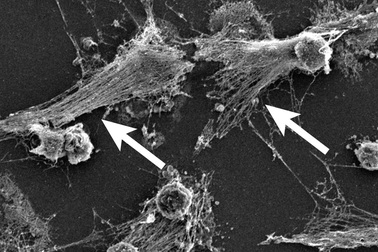 Các tế bào miễn dịch hoạt động quá mức gây tử vong cho bệnh nhân Covid-19?