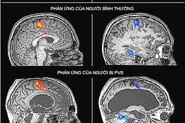 Bệnh nhân sống thực vật có thể “nói chuyện”
